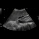 Thrombosis of inferior vena cava: US - Ultrasound